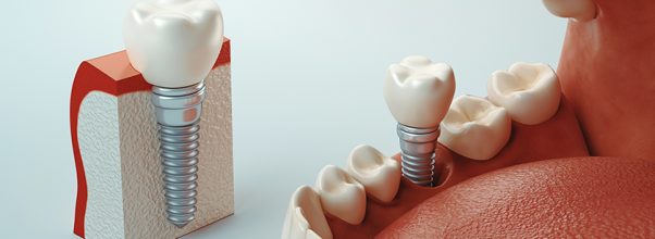 dental implants in Montreal